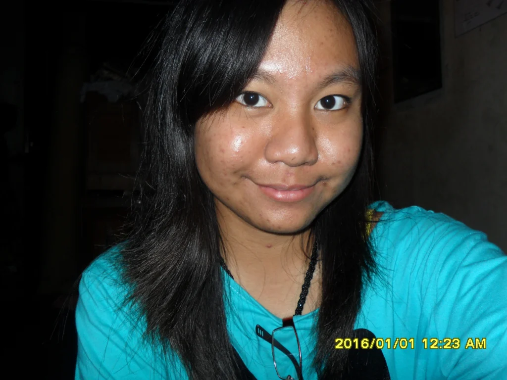 foto sebelum treatment natasha